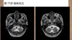 橄榄桥脑小脑萎缩的影像学诊断