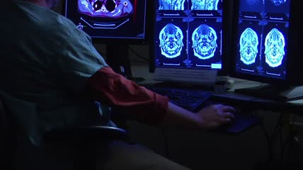 医生 看脑部CT透析  医疗
