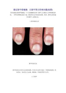 透过指甲看健康  白指甲预示肝病问题