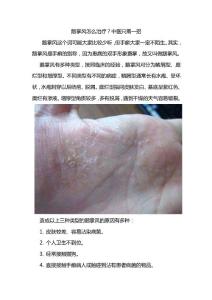 鵝掌風(fēng)怎么治？中醫(yī)只需一招