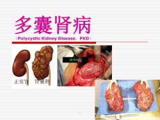 多囊肾ppt演示课件