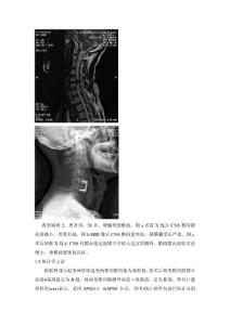 椎间隙高度变化对颈椎前路减压融合术后临床疗效影响的观察