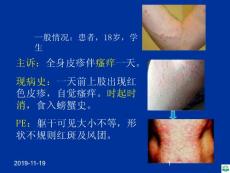学习_皮肤科荨麻疹ppt课件