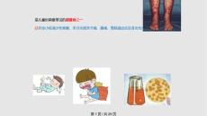 过敏性紫癜学习