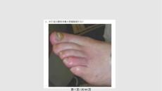 糖尿病足学习