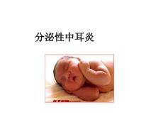 分泌性中耳炎