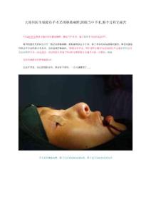 大連何醫(yī)生做隆鼻手術(shù)采用靜脈麻醉,睡眠當(dāng)中手術(shù),整個過程無痛苦