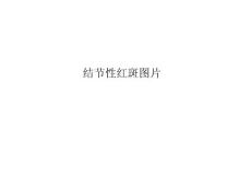 结节性红斑图片ppt课件