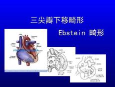 三尖瓣下移畸形ebsteinanomalyppt课件