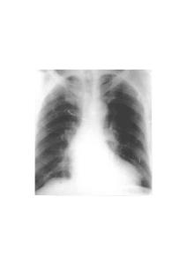 基本病變 左心室增大