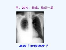 胸腔积液2