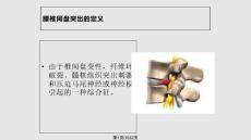 腰椎间盘突出