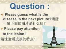 带状疱疹课件