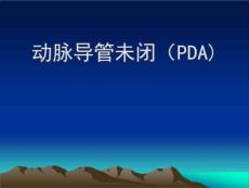 动脉导管未闭(PDA