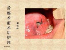 舌癌术前术后护理