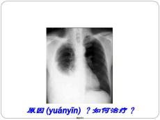 胸腔积液课件