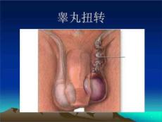 睾丸扭转课件PPT