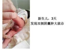 鞘膜外型睾丸扭转