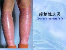 《接触性皮炎》