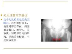 先天性髋关节脱位 (2）