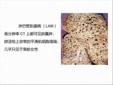 淋巴管肌瘤病的肺部CT表现
