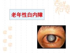 老年性白内障
