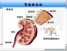 肾病综合征