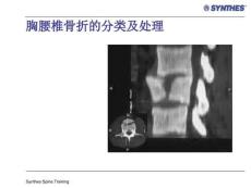 胸腰椎骨折课件