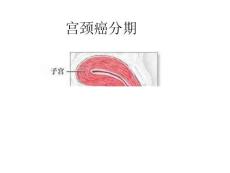宫颈癌分期