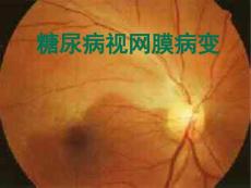 糖尿病视网膜病变1