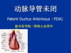 动脉导管未闭护理课件