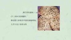 淋巴管肌瘤病的肺部CT表现课件
