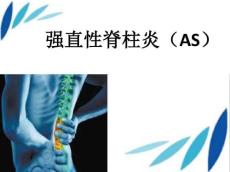 强直性脊柱炎14252
