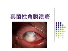 真菌性角膜炎