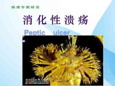 胃溃疡PPT课件