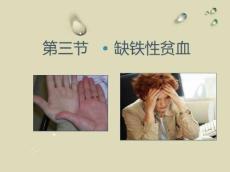 缺铁性贫血