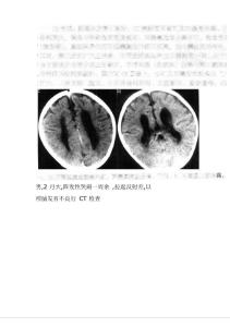 畸形：胼胝体发育不良