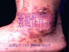 紫癜性肾炎【】