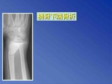 桡骨下端骨折