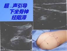 坐骨神经阻滞ppt课件