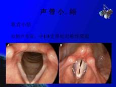 声带息肉声带小结人卫第八版ppt课件