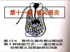 根尖周炎ppt课件