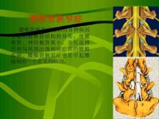 腰椎椎管狭窄症