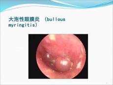 大泡性鼓膜炎(bullousmyringitis)课件