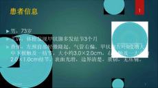 食管憩室的超声诊疗和鉴别诊疗培训ppt课件