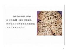 淋巴管肌瘤病肺部CT表现课件