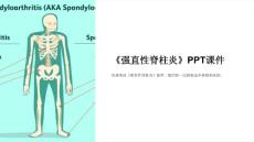 《强直性脊柱炎》课件