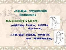 心肌缺血心电图课件