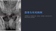 《股骨头坏死病例》课件