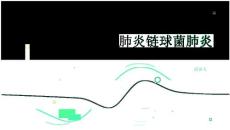 肺炎链球菌肺炎